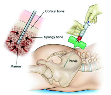 Bone Marrow Injection Stem Cell Therapy