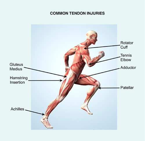 Common Tendon Injuries Treated with PRP