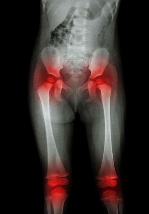 Hip And Knee Joint Injuries