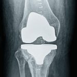 Joint Replacement Surgery Orthopedic Care