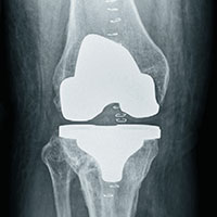 Charlottesville Orthopedic Joint Replacement