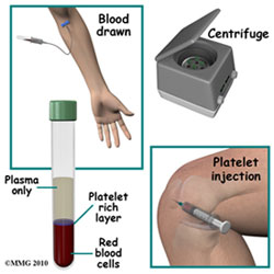 Platelet Rich Plasma Therapy Healing Injuries