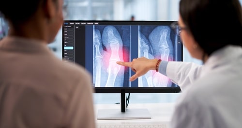 Fracture Care FAQ: Your Questions Answered Fretured Image